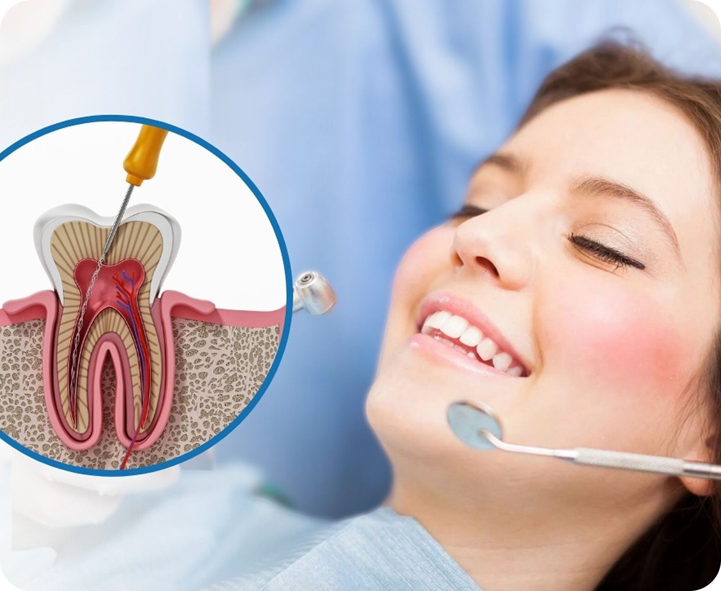 Painless Root Canal T/t