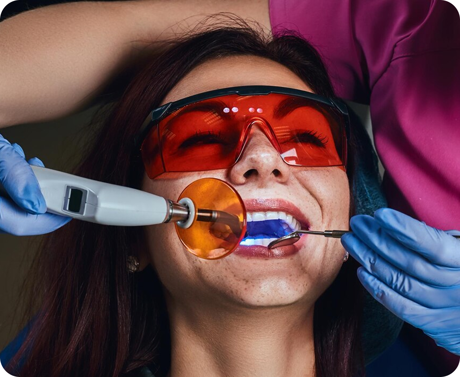 Dental Fillings