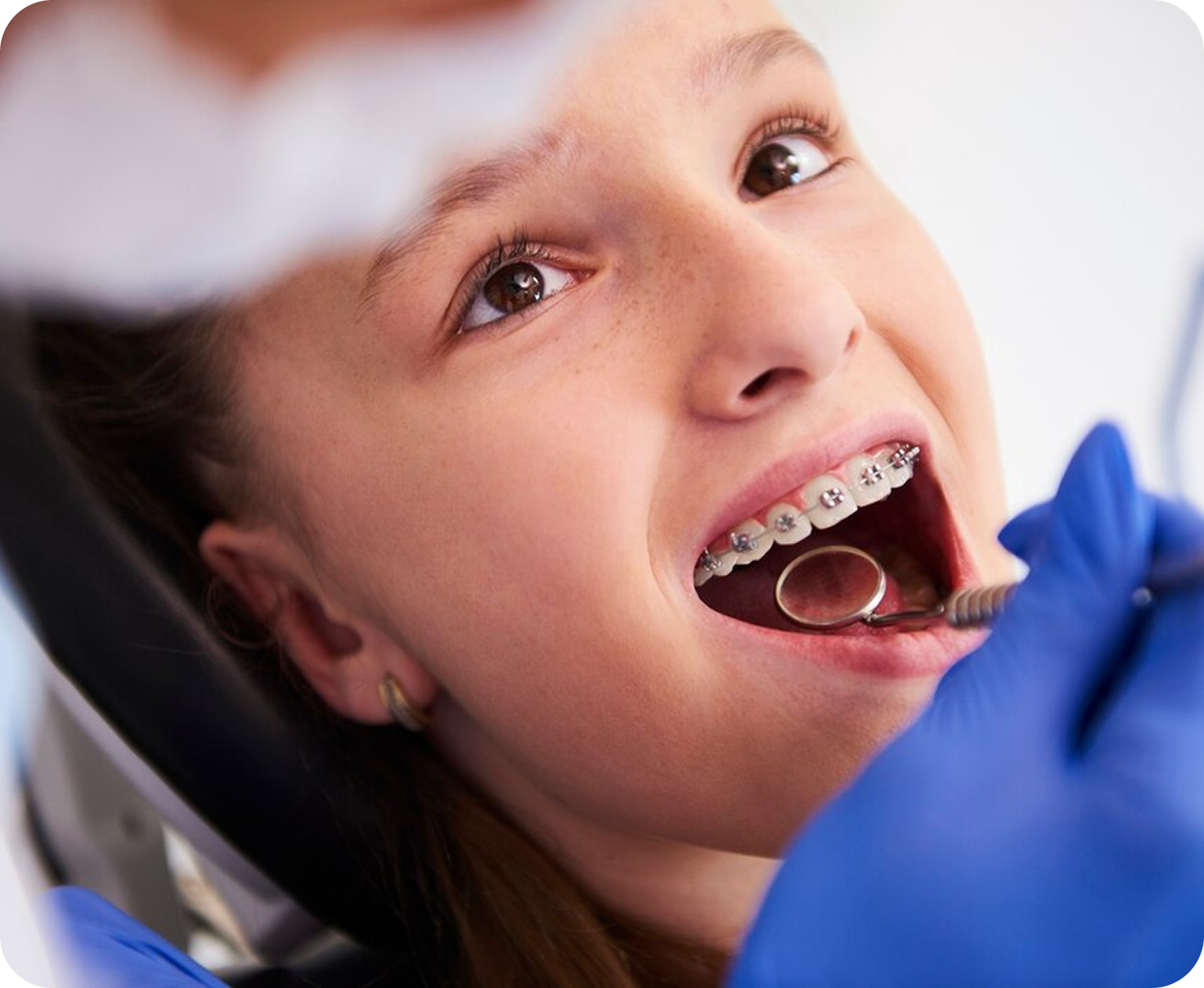 Metal & Ceramic Braces