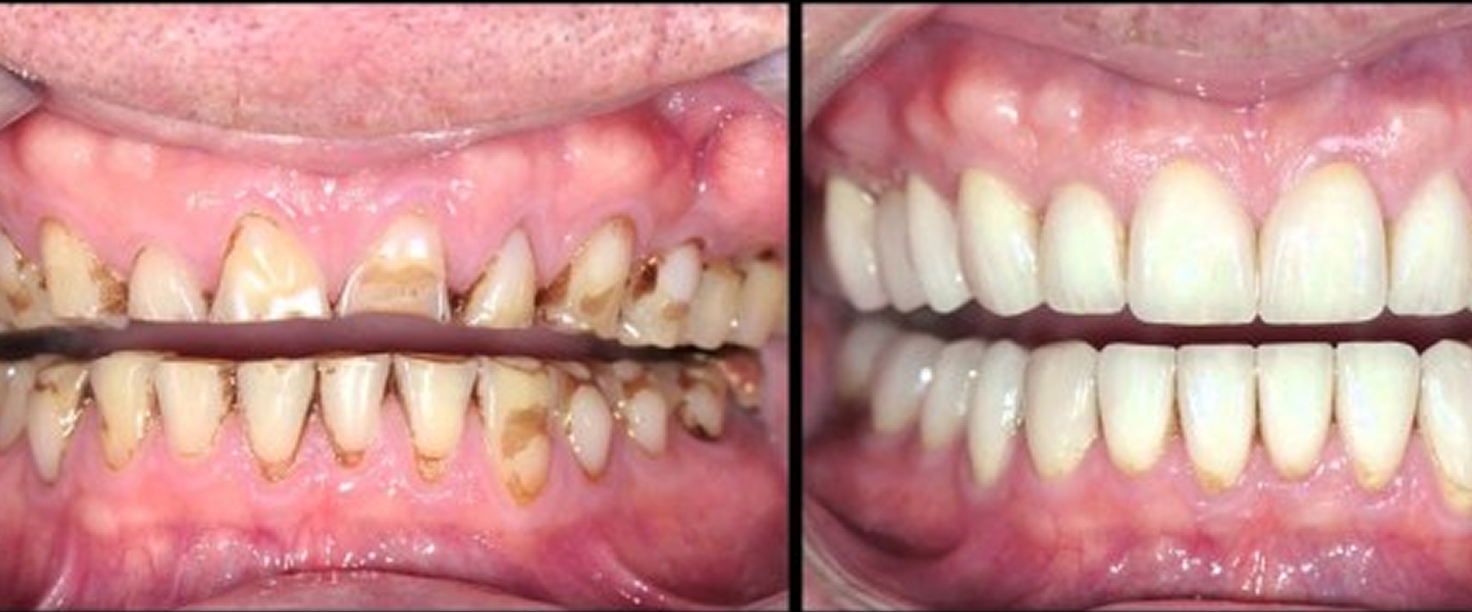 Full Mouth Rehabilitation