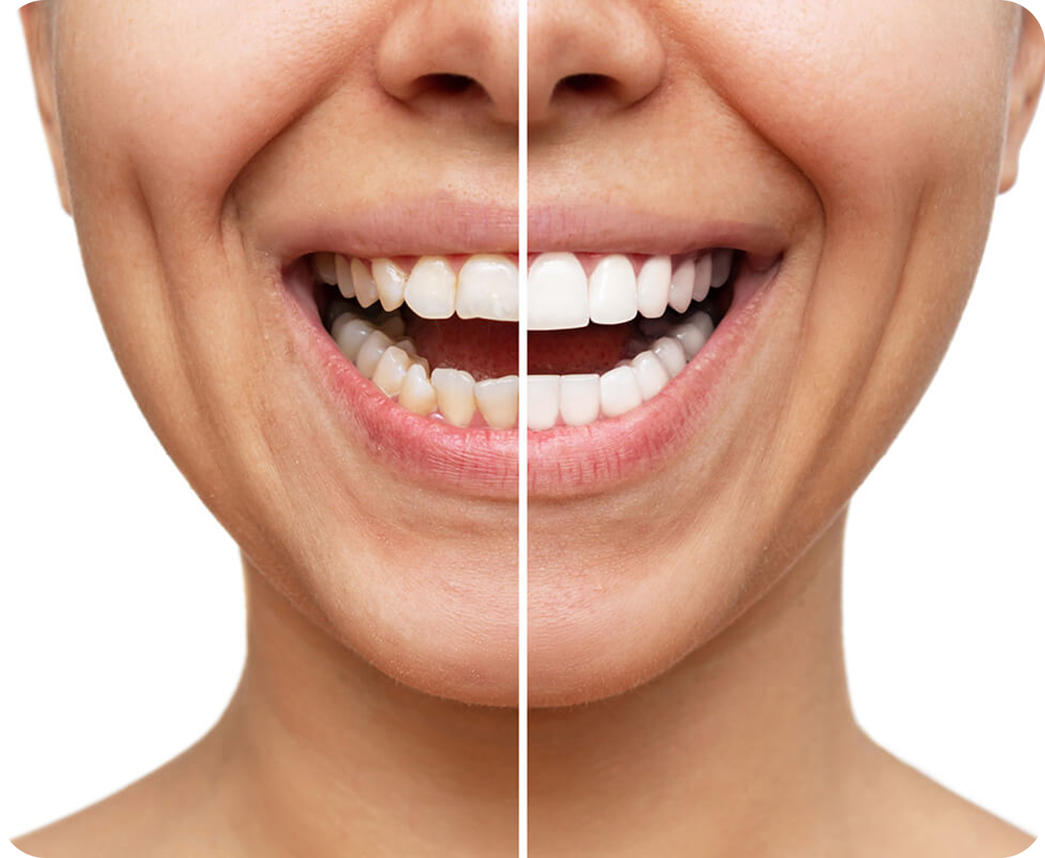 Veneers