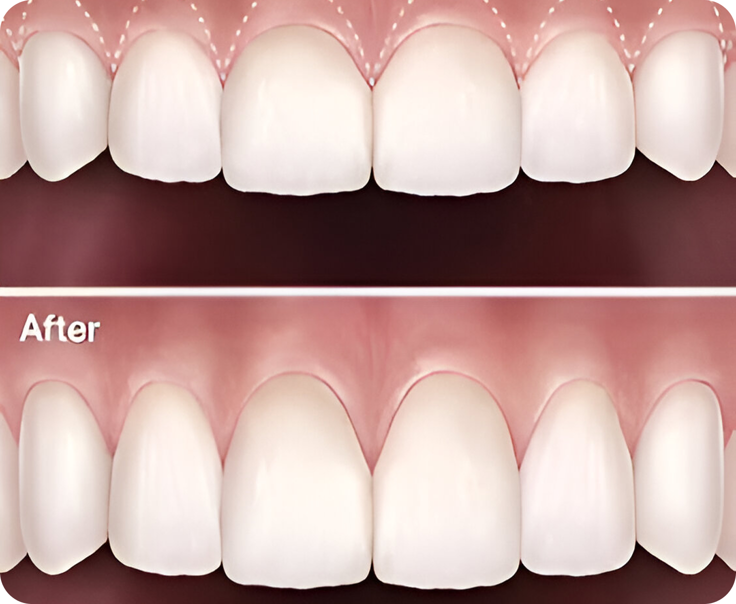 Cosmetic Gum Procedures