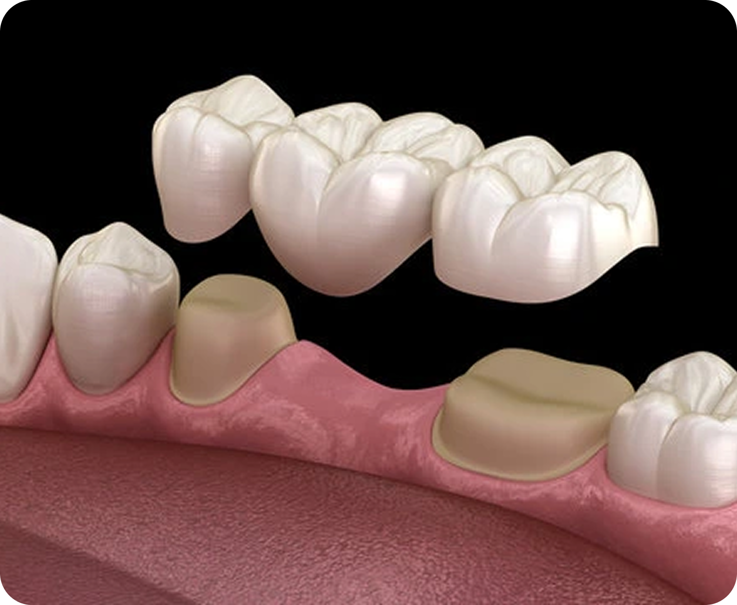 Dental Crowns & Bridges