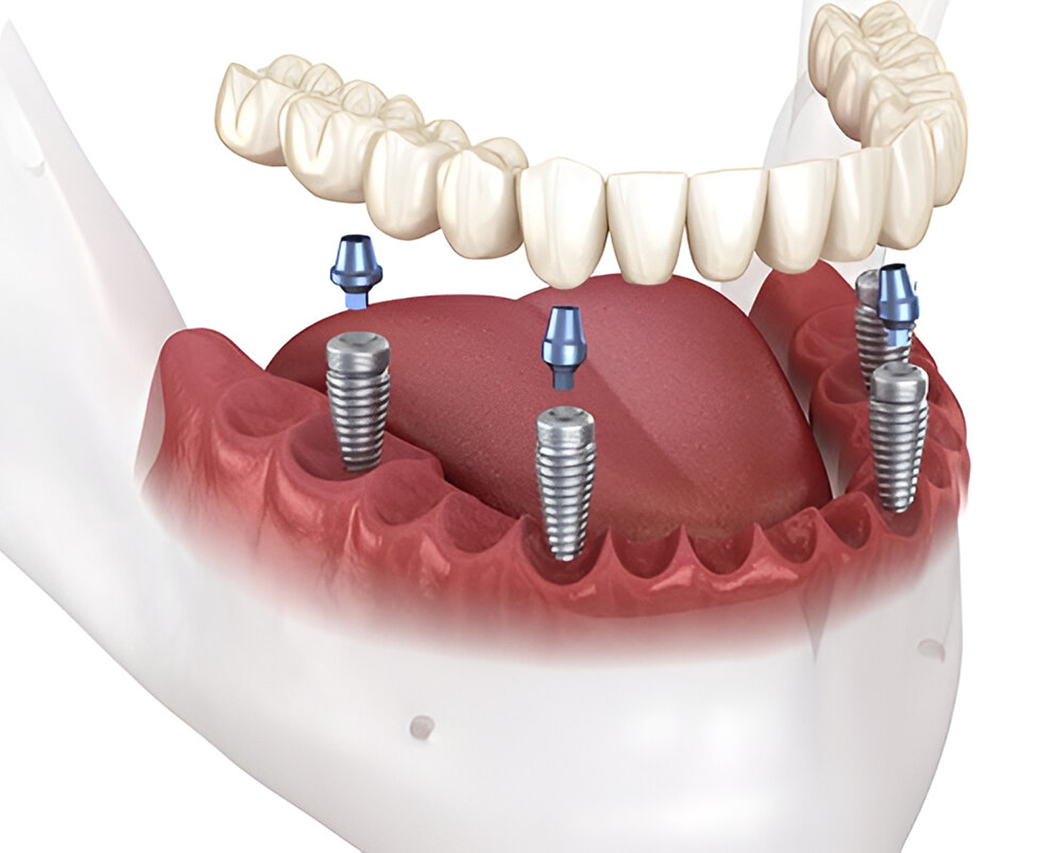 Full Mouth Implant